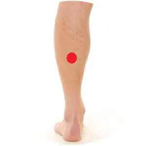 Blase 57 liegt direkt in der Unterschenkelmuskulatur.