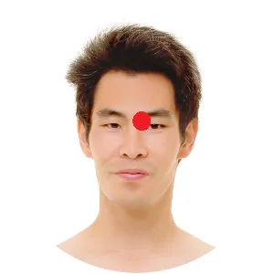 Blase 1 liegt an der Nasenwurzel im Bereich des Augapfels.