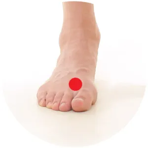 Leber 3 liegt zwischen im Gewebe zwischen dem Großzeh und dem Nachbarzeh.