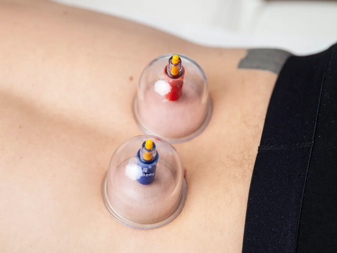 Heilpraktiker setzt Schröpfköpfe auf Patientenrücken